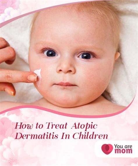 How To Treat Atopic Dermatitis In Children You Are Mom Treating