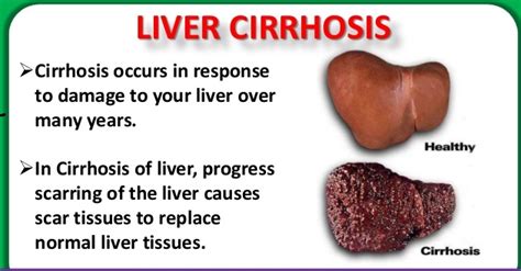 Facts About Liver Cirrhosis