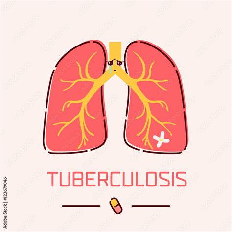 Tuberculosis Awareness Poster Cartoon Vector Cartoondealer Hot Sex Picture