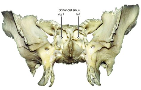 Sphenoid Bone Extracted Sphenoid Sinuses See Anterior View