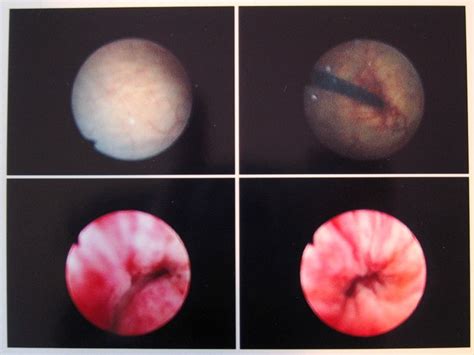 Treatment of bladder cancer depends on the stage of the cancer. File:Cystoscopy-im-20050425.jpg - Wikimedia Commons