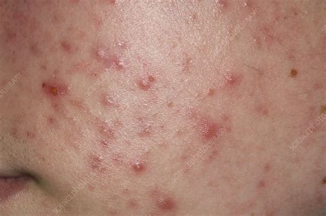 Acne Vulgaris On The Face Stock Image C0029547 Science Photo Library