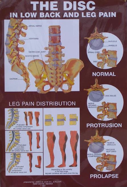Disc And Vertebrae Anatomical Poster Clinical Charts And Supplies