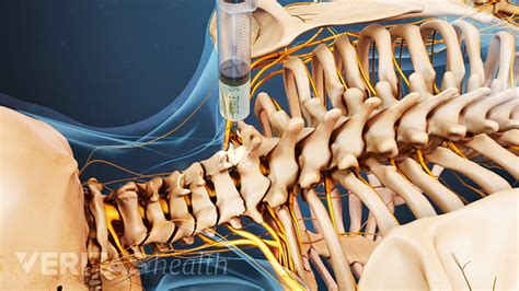 How Cervical Selective Nerve Root Blocks Can Ease Neck Pain