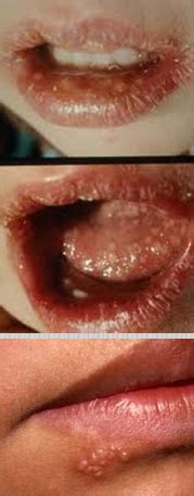 The systemic agents of choice to treat a yeast infection that affects the lips and tissues of the mouth, including the tongue, is called thrush. Viral and Fungal skin infections at Methodist College ...