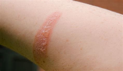 Three Main Layers Of Skin Burns