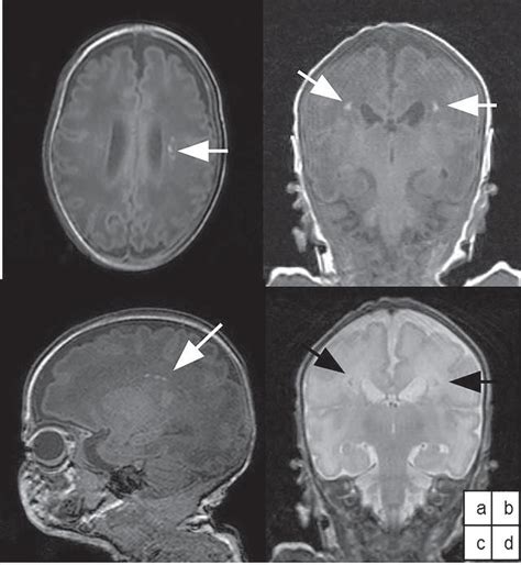 Isolated Neonatal Mri Punctate White Matter Lesions In Very Preterm