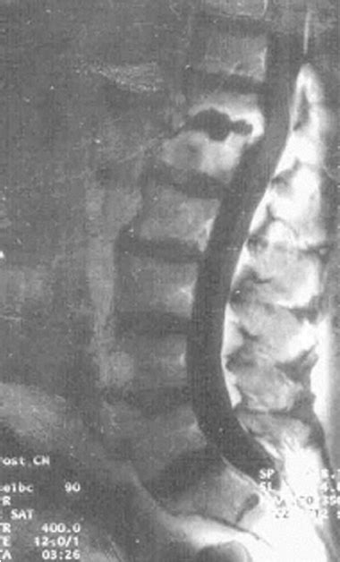 Mri Of The Spine Of A 74 Year Old Patient With An Infection Due To C