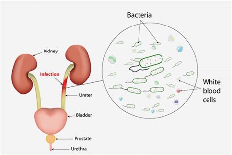 Urinary Tract Infection Uti In Pregnancy Symptoms And Treatment