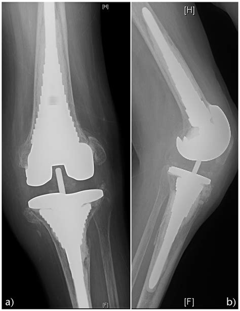 Management Of Bone Loss In Revision Total Knee Arthroplasty