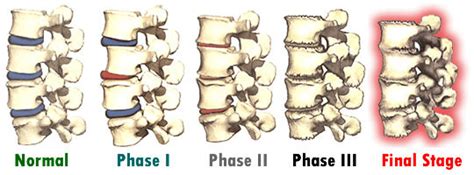 The Stages Of Degenerative Disc Disease Physiotherapists In Toronto