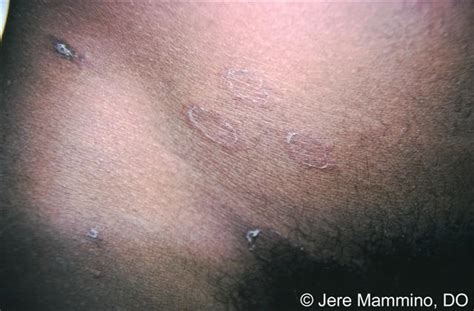 Pityriasis Rosea American Osteopathic College Of Dermatology Aocd