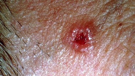 Skin Cancer Causes Signs Types And Symptoms