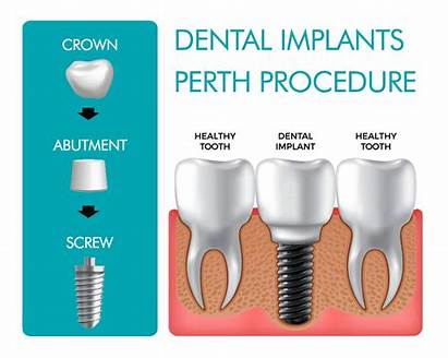 Dental Implants Perth Implant Explained Procedures Tooth