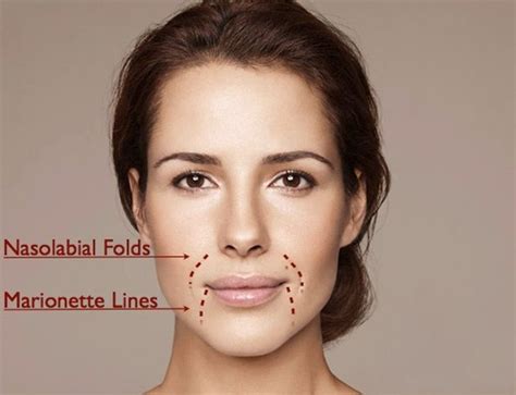 Marionette Lines Causes And Treatments Aesthetics Hub Marionette