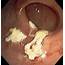 Quinidine Induced Gastric Ulcer  Gastrointestinal Endoscopy