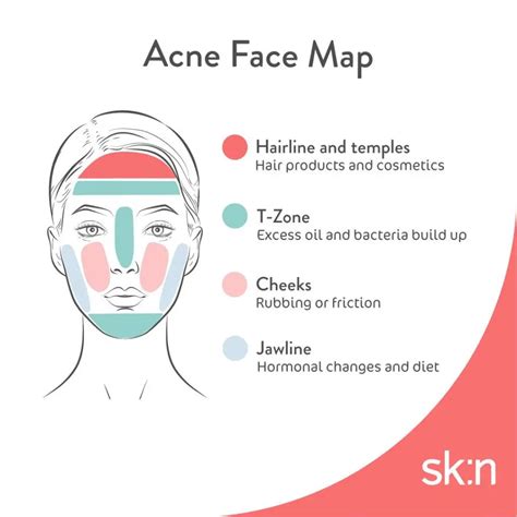 Use Our Acne Face Map To Find Out What Type Of Breakout Youve Got Sk