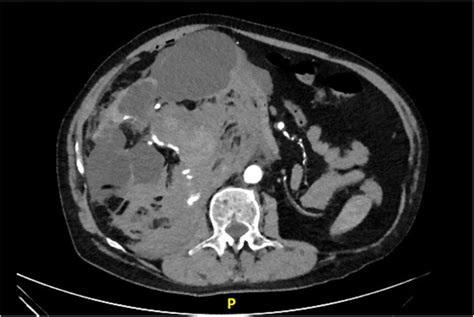 Axial Ct Scan Of The Abdomen And Pelvis Showing Active Contrast