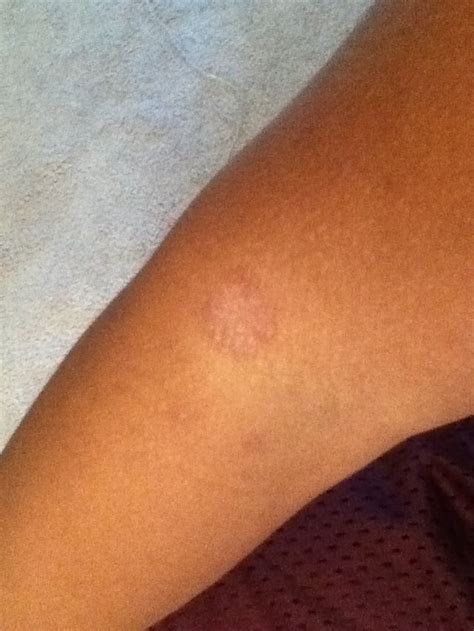 Sorry If It Isnt Clear But Is This Ringworm It Doesnt Itch Or Have