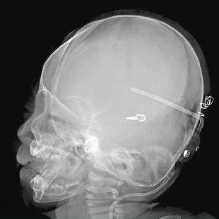 The Lateral Skull X Ray Shows Ventriculoperitoneal Shunt Device And