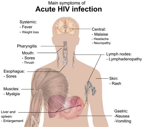 Filesymptoms Of Acute Hiv Infectionpng Wikimedia Commons