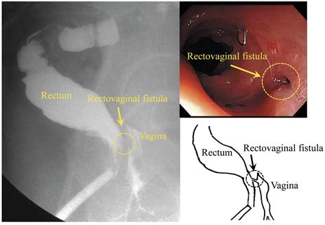 Surgical Strategy For Rectovaginal Fistula After Colorectal Anastomosis