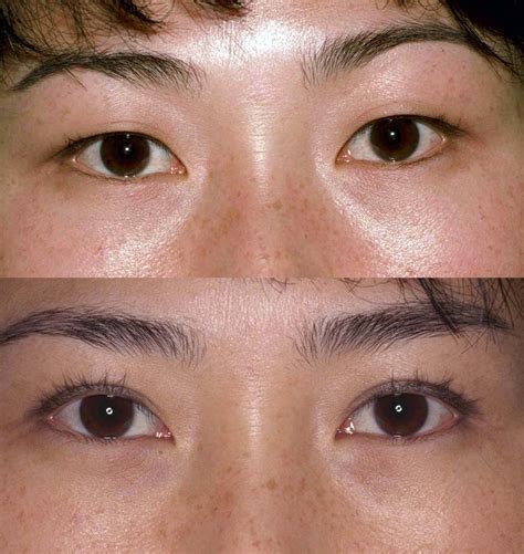 Asian Eyelid Surgery Is Not About Westernizing Lidlift