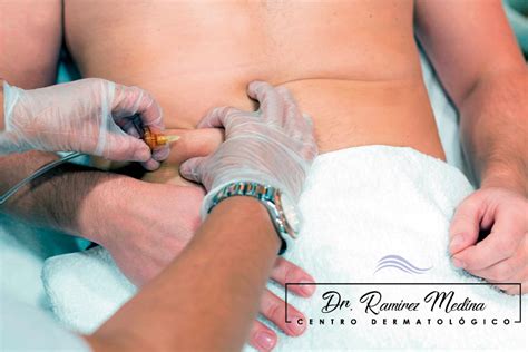 Centro Dermatológico Dr Ramírez Medina Sección Hombres Beneficios de la Carboxiterapia abdominal