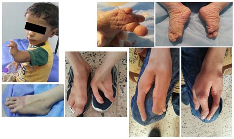 Information about depleted uranium, possible exposure during service, health effects, and related va programs. New Study Documents Depleted Uranium Impacts on Children ...