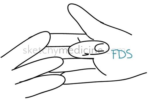 The key features of this technique are: Hand Exam: Motor 3/13 - Flexor Digitorum Superficialis ...