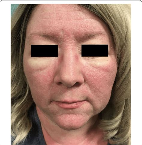 Clinical Features Of Dermatomyositis Including Facial Heliotrope Rash
