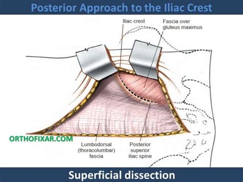 Posterior Approach To The Iliac Crest 2023 Orthofixar
