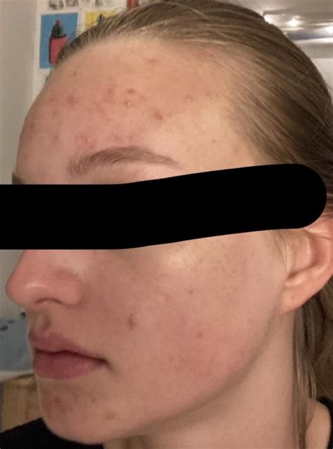 What Are These Tiny White Bumps On My Cheeks More Info In Comments