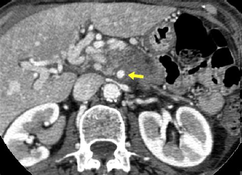 Radiographic Evidence Of Unresectable Pancreatic Cancer With Vascular
