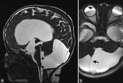 Rare Case Of A Rapidly Enlarging Symptomatic Arachnoid Cyst Of The