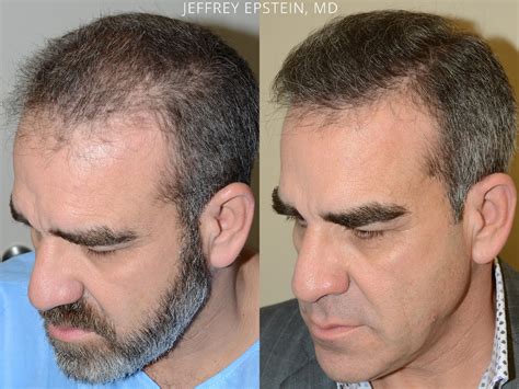 The reality is that today's hair transplant technology allows you to add thickness to. Hair Transplants for Men Photos | Miami, FL | Patient 54176