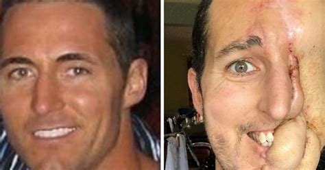 Tim Mcgrath New Hope For Man Who Lost Half His Face To