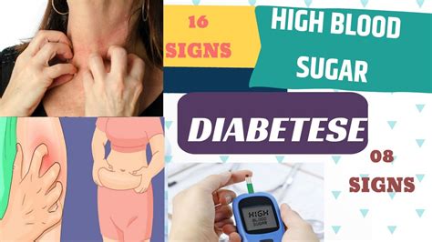 16 Signs And Symptoms That You Have High Blood Sugar And 8 Signs And