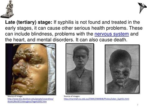 Ivms The Tuskegee Syphilis Experiment 75 Years Later