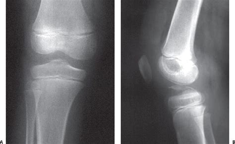Intra Articular Injuries Of The Knee Musculoskeletal Key