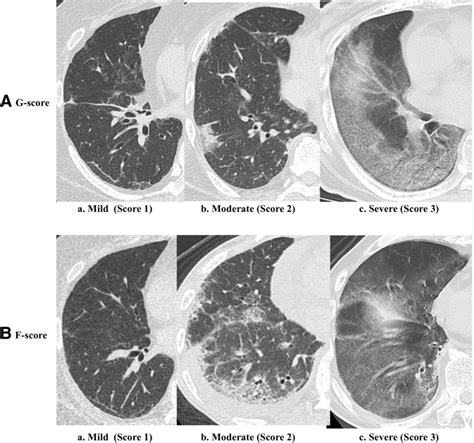 Assessment Of Rapidly Progressive Interstitial Lung Disease Rp Ild By