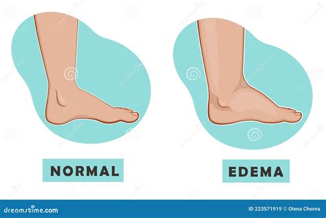 A Swollen Foot And Ankle And A Normal Foot Vector Illustration Stock