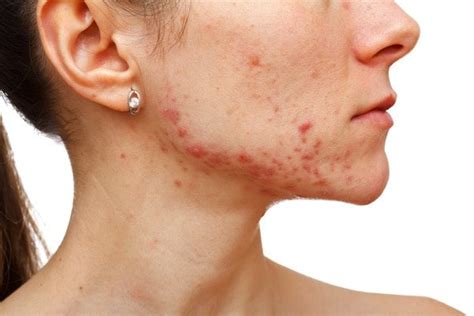 Acne Littekens Rode Vlekjes Na Puistjes Kun Je Verbeteren