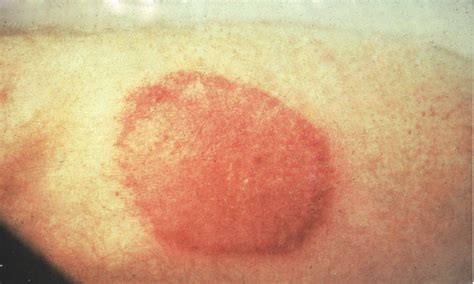 Lymes Disease Rash Pictures On Skin