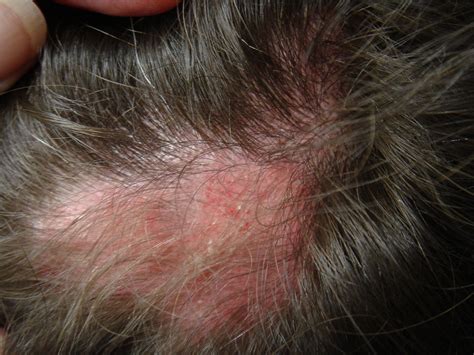 Check spelling or type a new query. Diskoider Lupus erythematodes - Deximed