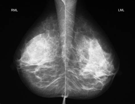 Mammography In Mediolateral Projection Stock Photo Image Of