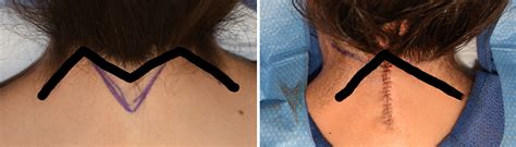 Webbed Neck Correction Hairline Change Dr Barry Eppley Indianapolis