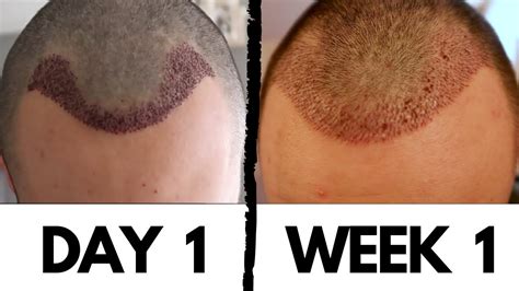 Hair Transplant Results After 1 Week How To Remove Scabs And Dry