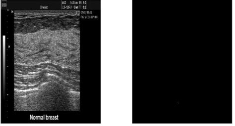 Normal Breast Ultrasound Ii The Medical Image In Figure 6 Above Is