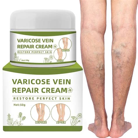 Buy Varicose Veins Cream Spider Veins Repair Cream Improve Blood